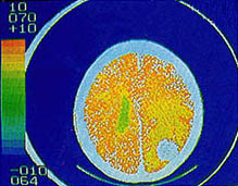 (사진4) CT촬영예. 그림 우하의 흰부분이 뇌종양