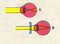 그림2 A:근시 B:오목렌즈를 이용한 근시의 교정