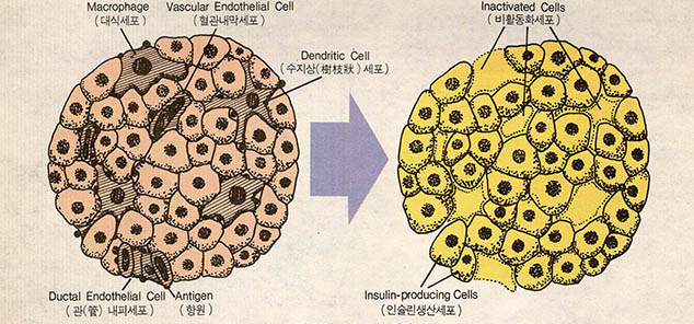 당뇨병치료를 위한 이식수술 원리
