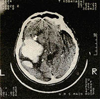 검사에서 뇌 내부에 혈종이 있는 것도 가려낸다.