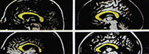 좌우의 뇌를 연락하는 뇌량은 여성쪽이 크다고 보고한 논문이 1986년 Trend in Neuroscience지 9월호에 발표되었다. 아래는 사진이고 왼쪽은 단면의 모양이다. 뇌 전체는 남성쪽이 크고 여성은 뇌량이 크다.