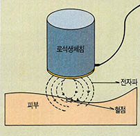 (그림1)자동적으로 혈점으로 유도되는 바늘없는 침