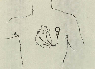 심장의 박동이 원활하지 못하면 전기 배터리나 핵배터리를 활용하기도.