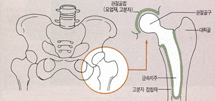 (그림3) 인공관절(hip joint)