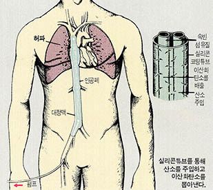 인체에 산소를 공급하려는 연구는 1세기 동안 계속돼 왔다.