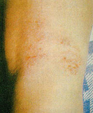 태열^아토피부염을 가진 어린이는 알레르기성 비염이나 알레르기성 두드러기에 걸릴 가능성이 많다.