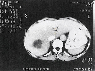간암의 단층 촬영 사진