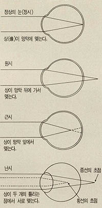 (그림2) 정상안과 굴절이상