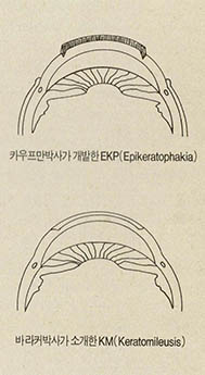 (그림5)각막실질을 이용해 ···