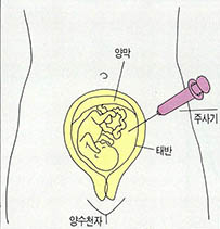 (그림 3) 임신 16,17주 사이에 실시하는 양수검사