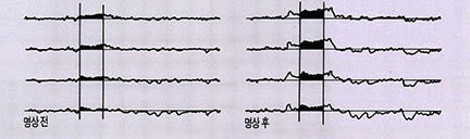 초월명상 전후의 뇌파변화