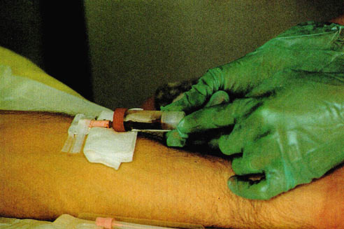 AIDS환자의 혈관에 강력한 항바이러스제인 AZT를 투여하고 있다.