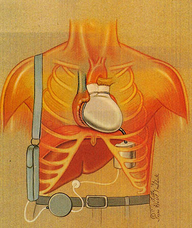 THI의 인공심장은 흉강(thoracic cavity) 부위에 장착될 것이다.