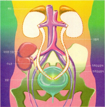 (그림6) 신장이식 과정^질환이 있는 신장은 제거하고 신장 동맥과 정맥은 부신에 연결된 것을 제외하고는 봉합시켜 버린다.