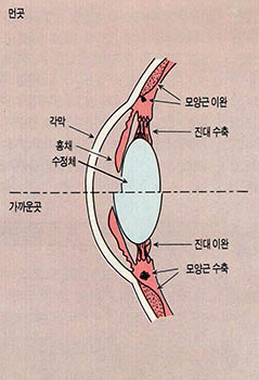 (그림3) 눈의 원근조절