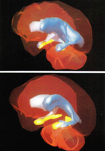 (그림1) 정신분열증 환자에게 나타난 뇌 구조의 변화^위의 정신분열증 환자의 뇌는 위축된 해마(노란 부분)와 확장된 뇌실(회색 부분)이 눈에 띈다. 아래는 정상인의 뇌. 3차원 MRI사진이다.