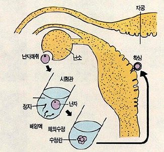 (그림4) 시험관 아기의 착상 과정