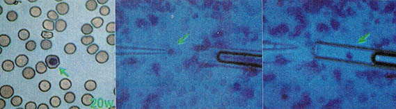 사진 왼쪽은 탯줄 혈액 속의 유핵 적혈구. 가운데와 오른쪽은 유핵 적혈구를 유리판으로 흡인하는 모습