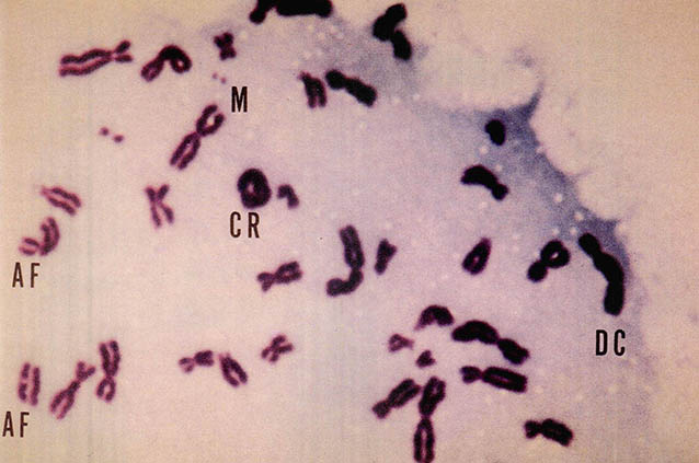 방사선 피폭후의 인체 염색체. X자 모양을 한 것이 정상이고 영문표시된 것이 이상염색체다(CR : 원형으로 서로 붙은 것. DC : 중복X자 AF, M : 염색체조각).