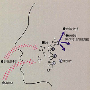 알레르기성 비염 어떻게 일어나나^①알레르겐이 들어오면 ②비만세포에 부착된 lgE 항체가 이를 포착한다. ③비만세포에서 화학물질이 분비된다. ④화학물질에 의해 알레르기반응이 일어난다.