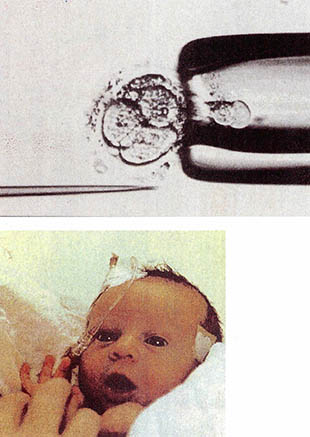 피펫에 빨려 즐어가는 세포. 흡인은 현미경 아래에서 행해진다(위). 착상 전 진단을 받고 태어난 아기 엘리자베스의 올해 5월모습 이 아기는 유전병인 근육디스트로피에 걸릴 가능성이 있었다(아래).