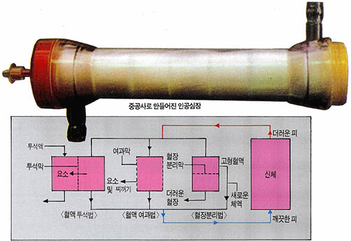 (그림1) 인공 신장기의 종류와 방법