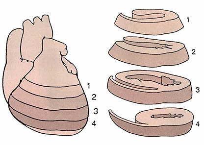 (그림1) 심장의 4개 단면
