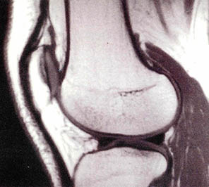 (사진2) 무릎관절 MRI 사진