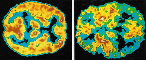 뇌의 PET 스캔 사진. 왼쪽은 정상노인, 오른쪽은 알츠하이머 환자의 것이다. 환자쪽이 검게나온 부분이 많은데, 그만큼 뇌가 손상됐다는 뜻이다.