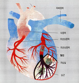 관상동맥에 지방이 축적되면 혈관이 좁아지고 혈전이 만들어져 심장마비를 일으킨다. 사진은 좌관상동맥에 혈전이 형성된 모습.