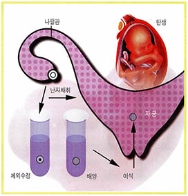 (그림1) 시험관 아기 탄생과정