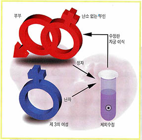(그림2) 난자제공 임신과정