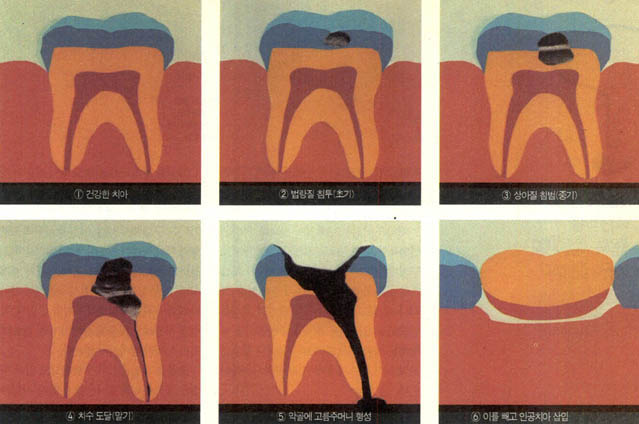 (그림) 충치의 진행과정