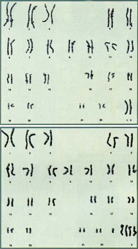 X염색체를 두개 가지고 있는 정상적인 여성의 염색체, XXXXY염색체를 클라인펠터 증후군의 염색체 모양.