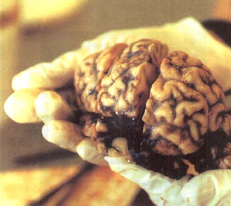 광우병에 걸려 죽은 소의 뇌.