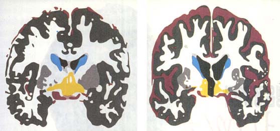 자가공명장치 영상으로 본 뇌^알콜올 환자(우)의 경우 정상인(좌)에 비해 뇌 표면의 뇌척수액(빨간색)의 크기가 증가한 반면, 해마가 있는 측두엽 부위(푸른색)와 간뇌(노란색)가 크게 줄어들었다.