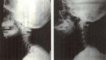 정상적인 목(좌)과 비정상적인 목뼈(우)의 X선 사진. 목뼈는 머리를 지탱하므로 매우 중요하다.