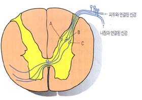 (그림4)폭주-투사설^A는 피부로부터 오는 자극을 전달하는 신경이고 C는 내장에서 오는 자극을 담당하는 신경이다.B는 양쪽 모두의 자극을 전달받기 때문에 대뇌는 통증의 원인을 혼동하게 된다.