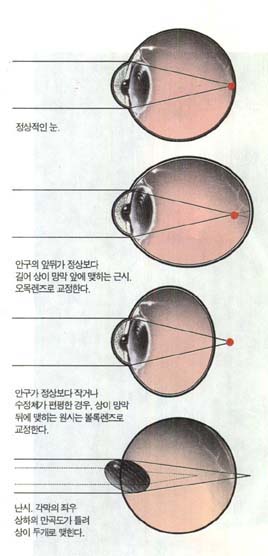 정상적인 눈과 비정상적인 눈