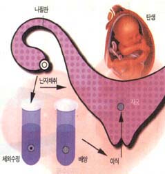 시험관 아기 탄생과정