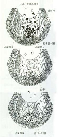 동맥경화 형성과정^손상된 동맥내피를 통해 LDL과 혈소판이 침투한다.혈소판에서 나옹ㄴ 성장인자의 작용으로 내피 아래층의 평활근세포가 분열해 손상된 부위로 이동한다(위).동시에 백혈구의 일종인 단구가 부위에 침투,활성화돼 대식세포가 된다(가운데).평활근세포와 대식세포는 LDL을 섭취해 분해시킨다.그 결과 공포세포가 형성된다.만일 혈중 LDL농도가 지나치게 높으면 그곳에 포함된 콜레스테롤이 공포세포내에 축적된다.이와같이 축적된 콜레스테롤,세포,부스러기 등에 의해 동맥이 점차 좁아지며 동맥경화가 된다(아래).