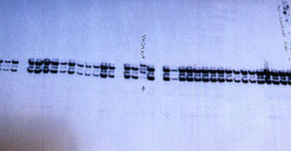 17번째 염색체의 BRCA1유전자를 나타내는 유전자지도,BRCA1은 유방암과 관련있는 것으로 알려졌다.