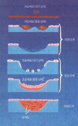 (그림)뼈의 재형성 과정^파골세포가 뼈의 낡은 부위를 갉아 없앤 후(파쇄단계),조골세포가 메꿈으로써(형성단계) 새로운 뼈가 형성된다.