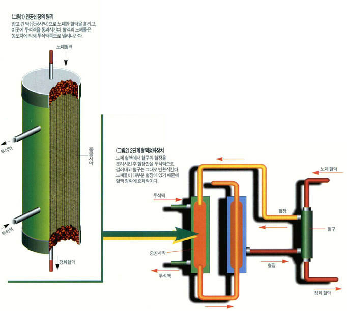 (그림1)인공신장의 원리^얇고 긴 막(중공사막)으로 노폐한 혈액을 흘리고, 이곳에 투석액을 통과시킨다. 혈액의 노페물은 농도차에 의해 투석액쪽으로 밀려나간다. (그림2)2단계 혈액정화장치^노폐 혈액에서 혈구와 혈장을 분리시킨 후 혈장만을 투석액으로 걸러내고 혈구는 그대로 반환시킨다. 노폐물이 대부분 혈장에 있기 때문에 혈액 정화에 효과적이다.