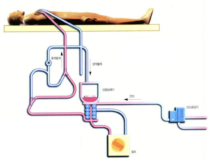 (그림1)인공심폐기 사용 개념도^심장이나 폐를 수술할 때 폐를 대신해 산소를 공급하고 이산화탄소를 제거한다. 정맥혈액이 인공심폐기를 통과하면서 피는 신선한 산소를 공급받고 다시 수술중인 환자몸으로 들어간다. (그림2)막형 인공심폐기^혈액이 가느다란 막을 통과할 때 산소가 공급되는 원리다.