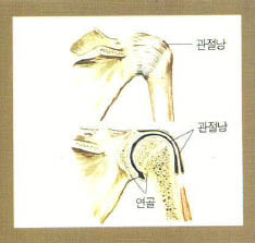 (그림)어깨 관절 모식도^어깨뼈와 팔뼈가 연결되는 부위에 연골이 있고, 그 외부를 관절낭이라는 결합조직이 둘러싸고 있다.