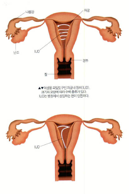 여성용 피임도구인 자궁내 장치(IUD). 크기와 모양에 따라 수백 종류가 있다. IUD는 병원에서 삽입하는 편이 안전하다.