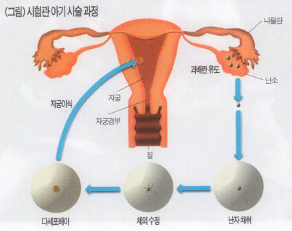 (그림)시험관 아기 시술 과정^시험관 아기 시술은 과배란유도, 난자채취, 체외수정, 배양, 다세포배아의 자궁이식의 순서로 시행된다.