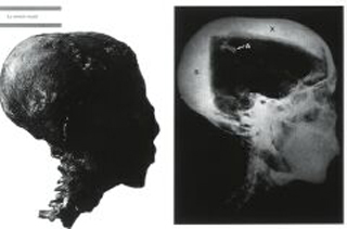 투탕카멘의 머리(왼쪽)를 X선으로 검사한 모습(오른쪽). A라고 표시한 부분이 타살을 시사하는 두개골 파열 흔적이다.