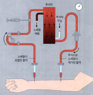 (그림2) 혈액 투석 모델^투석막에서 농도차이에 의해 깨끗한 피로 걸러지는 것이 혈액 투석의 기본 원리다.